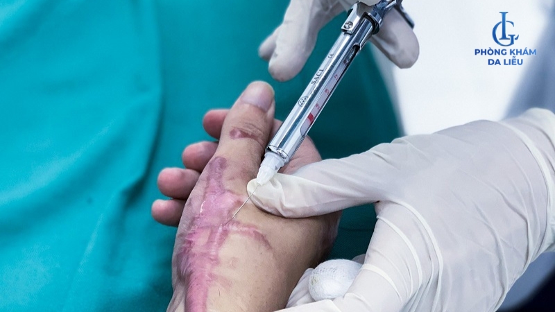 Tiêm trị sẹo lồi