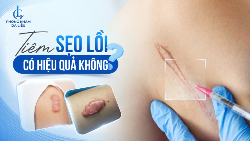 Tiêm sẹo lồi có hiệu quả không?