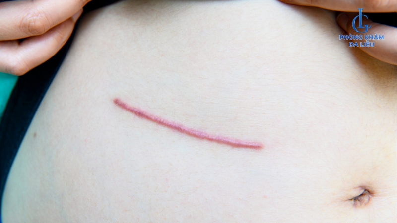 Sẹo lồi ở bụng