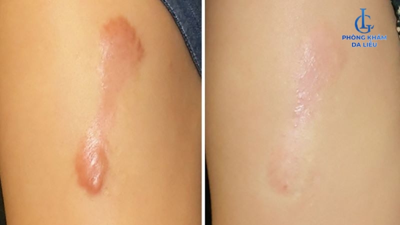 Tiêm sẹo lồi bao lâu thì xẹp?