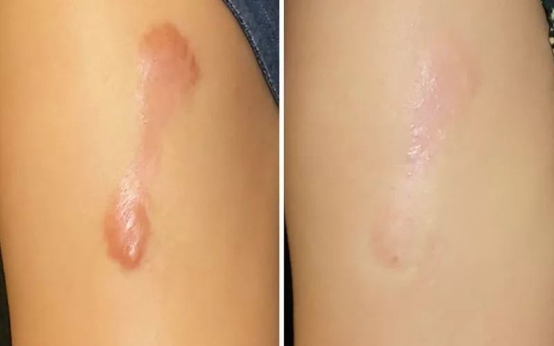 hình ảnh trước và sau khi điều trị sẹo lồi