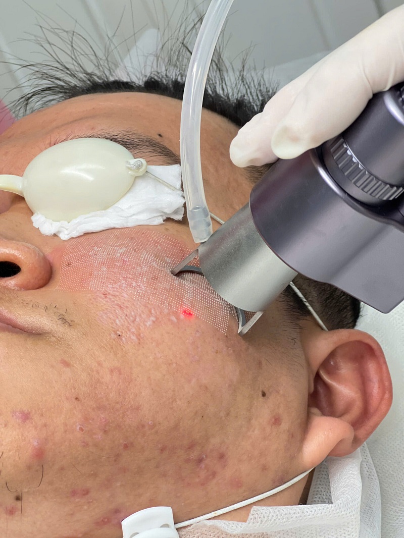 đốt sẹo lồi bằng laser