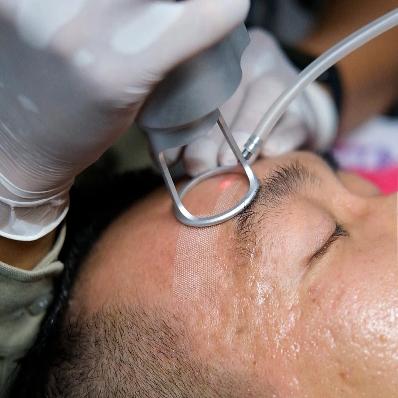 bắn laser trị sẹo lồi