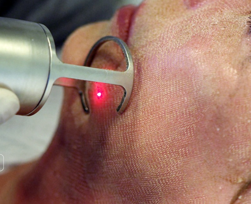 Trị sẹo lồi bằng laser có hiệu quả không?