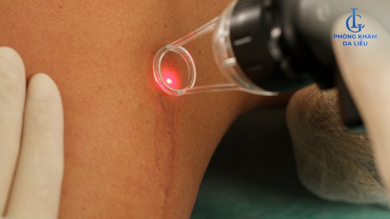 Trị sẹo lồi bằng laser giá bao nhiêu?