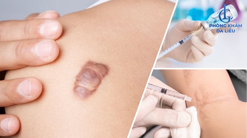 Tiêm corticosteroid