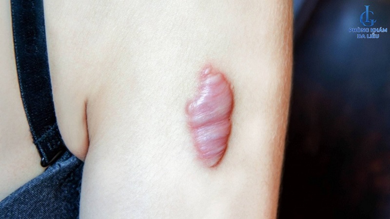 Sẹo lồi lâu năm